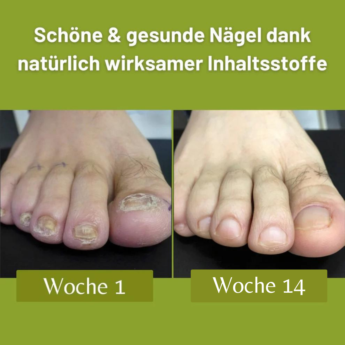 H-Fungus® Nagelpflegestift - Mit Rosmarinkomplex